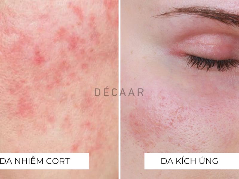 Phân biệt da nhiễm corticoid nhẹ với tình trạng da kích ứng